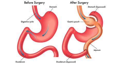 best gastric sleeve surgery turkey.